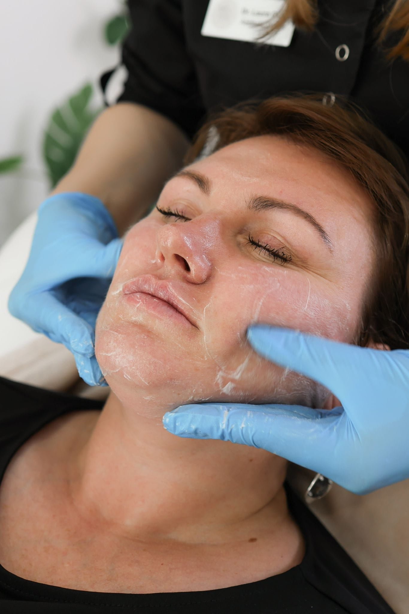 Cosmelan Depigmentation Peel for Skin Brightening in the UK