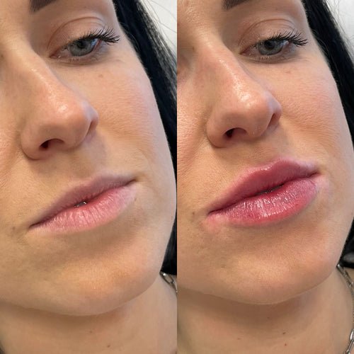 What Does 2ml Lip Filler Look Like