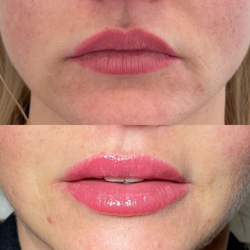 What Is The Most Natural Lip Filler