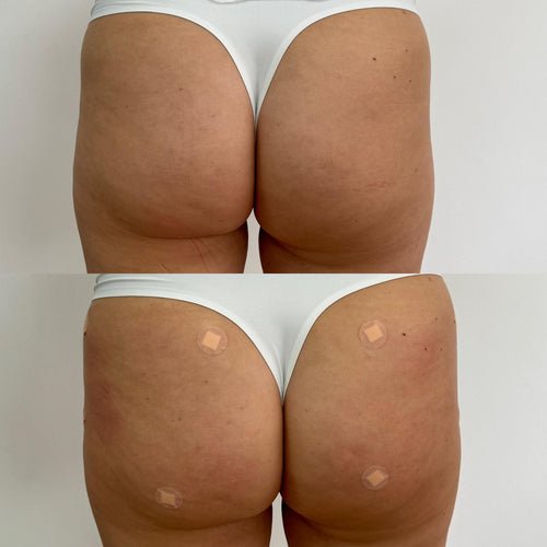 Non-Surgical Brazilian Bum Lift in Brockham Surrey