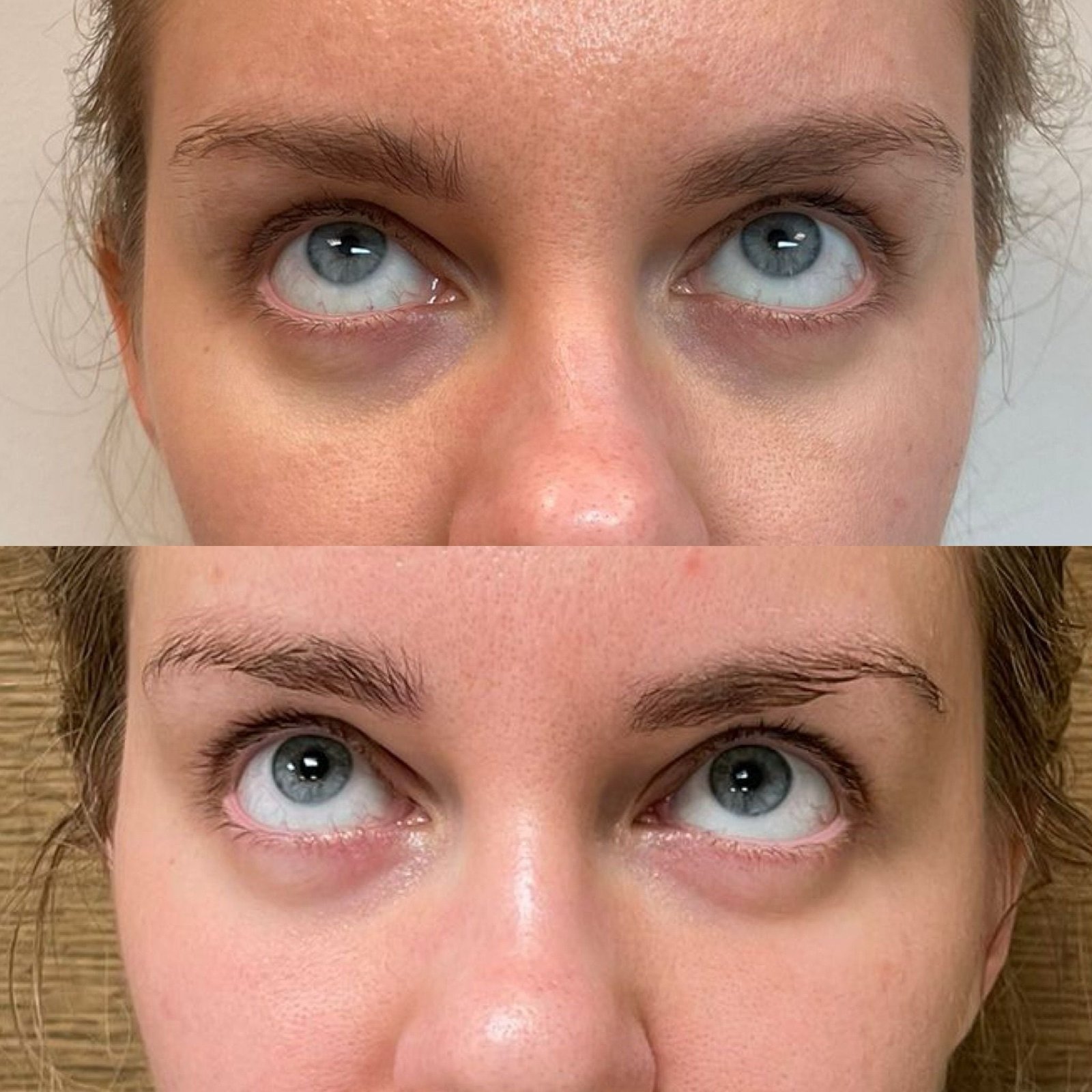 Polynucleotide Injectables Revolutionising Skin Rejuvenation in the UK