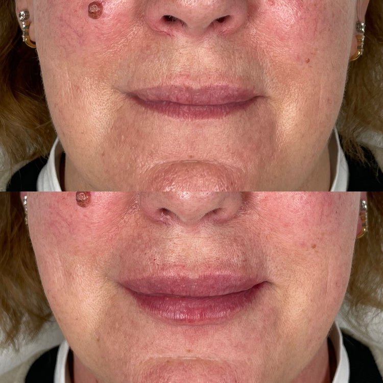 Botox Brow Lift in Green Park, London